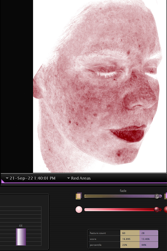 Redness levels revealed by the Visia skin scan
