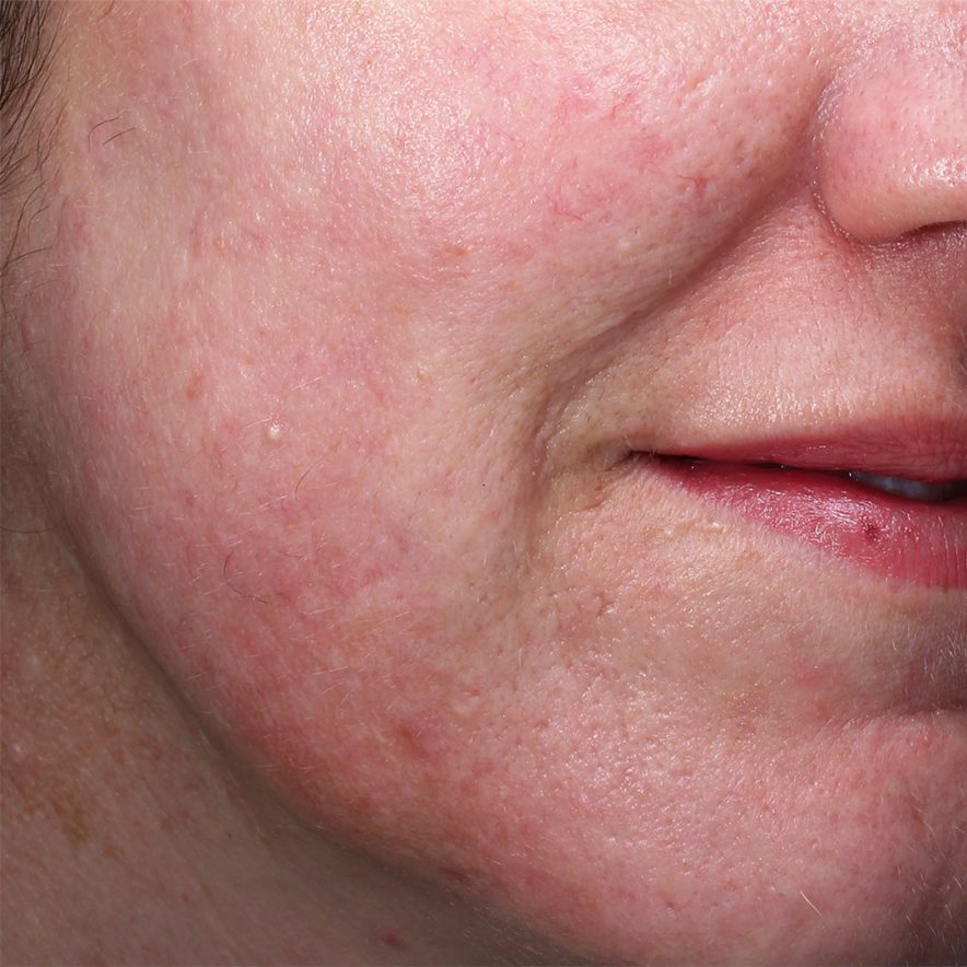 How To Calm Skin Redness On Face?