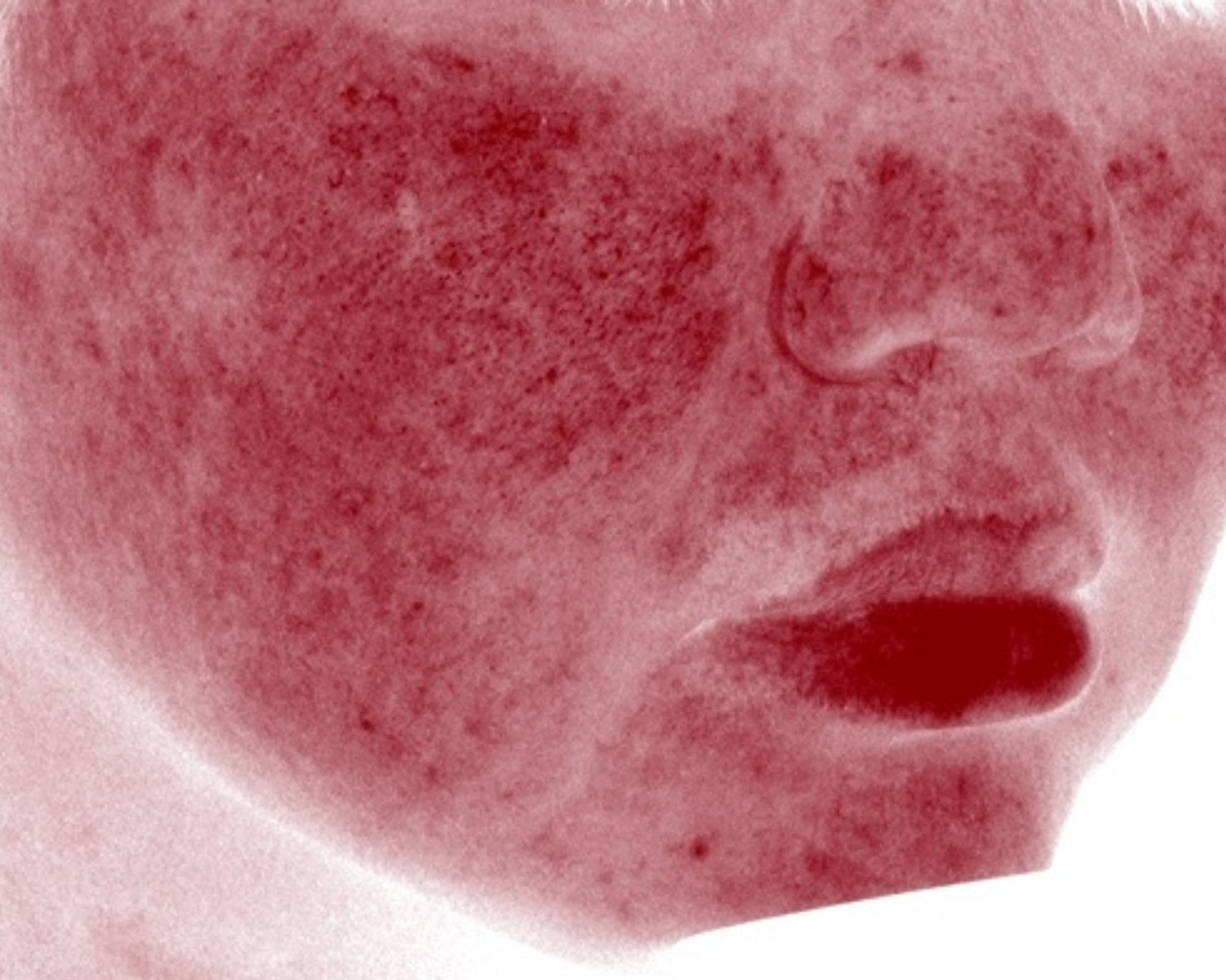 Inflamed skin as shown on the VISIA