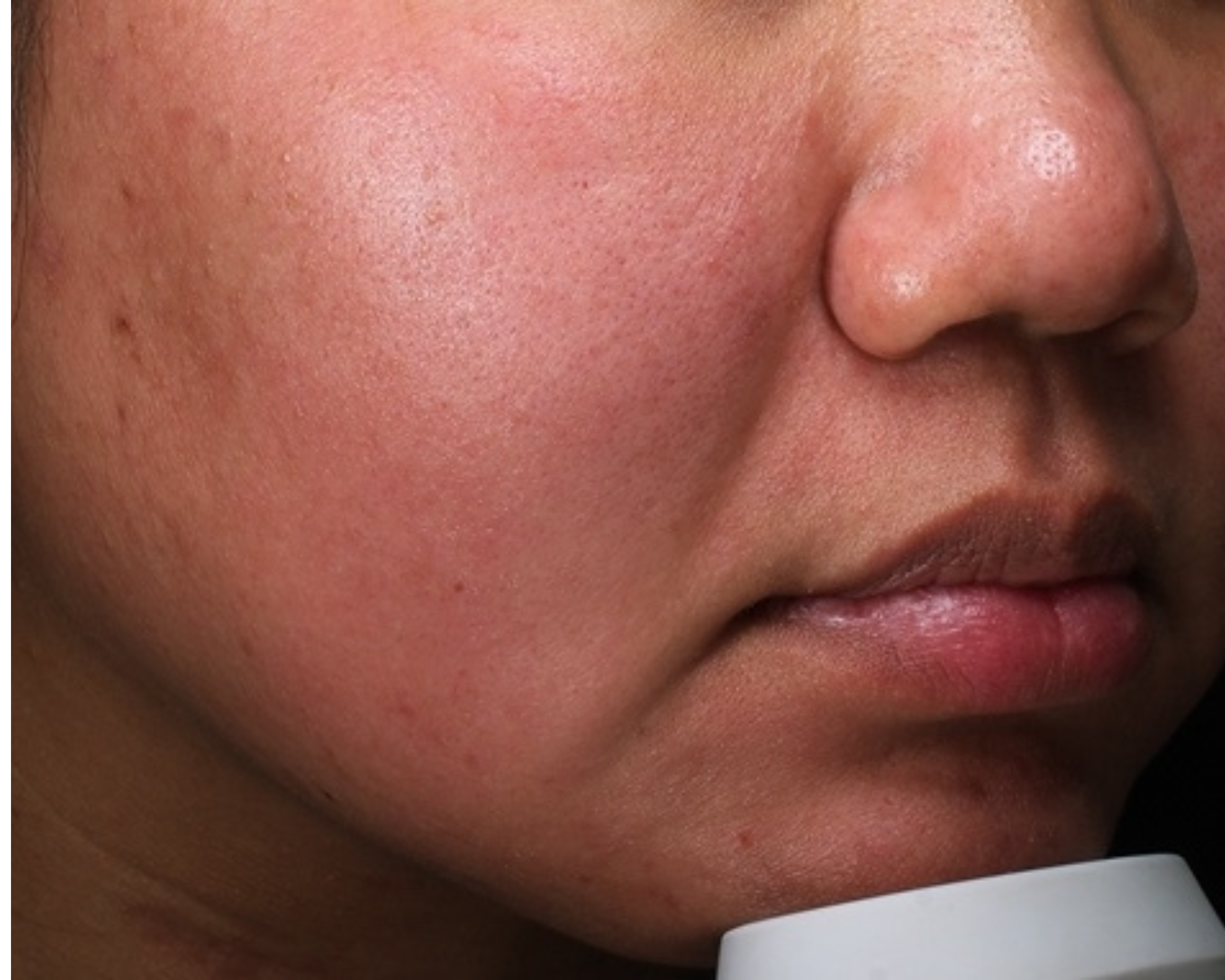An example of inflamed skin.